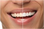 tooth discoloration