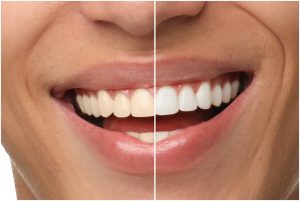 tooth discoloration