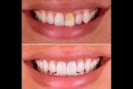 teeth discoloration caused by habits