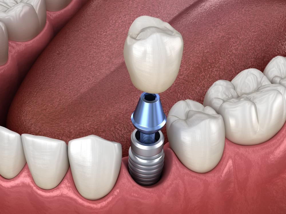 dental -implants -edmonton