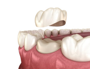 Few Things About Dental Crowns