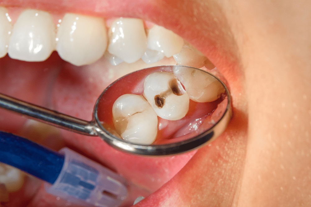 Guidelines for Post-Dental Fillings What to Do and What to Avoid