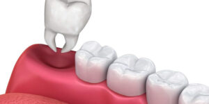 tooth-reconstruction-edmonton