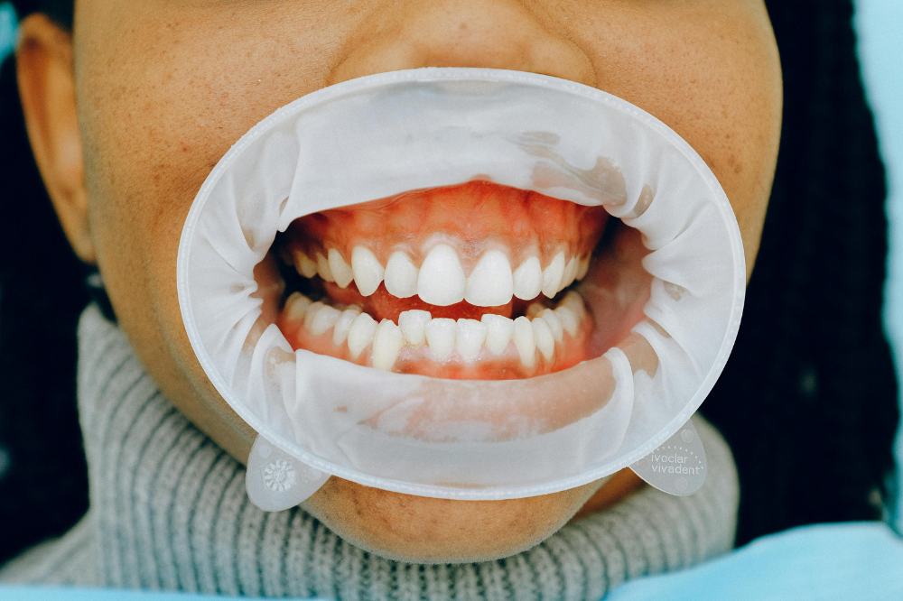 A Guide to Gum Health Treatment after Gingivitis