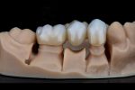 dental bridges in edmonton