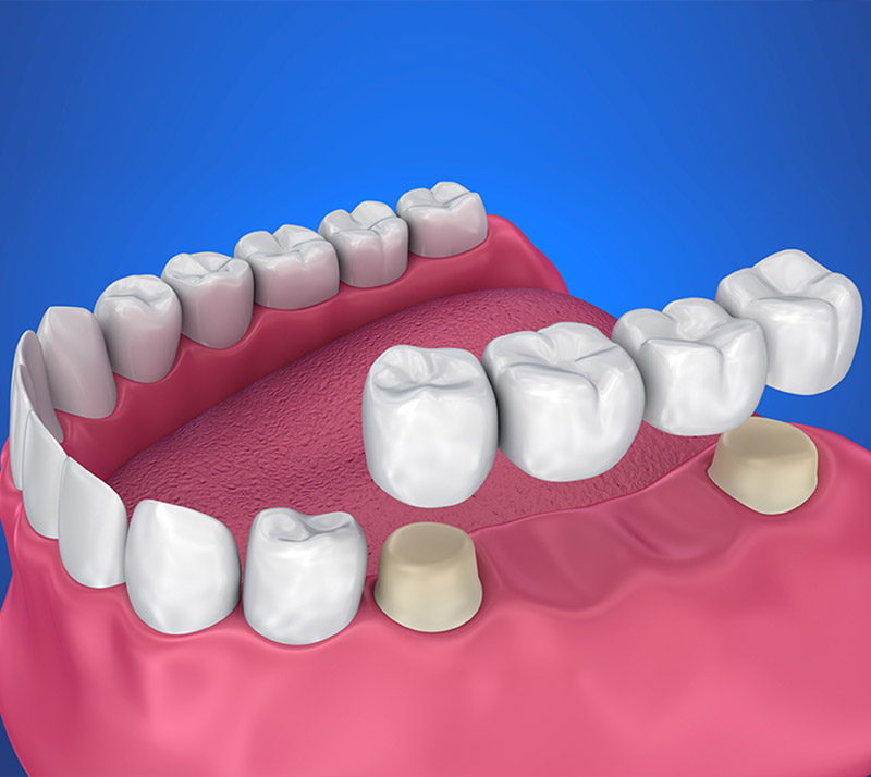 dental-bridges-near-you