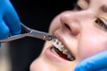 a dentist is putting orthodontics on a lady