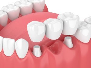 few-things-about-dental-bridges-edmonton