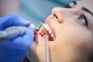 few-things-about-dental-cleanings