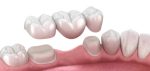 dental crowns