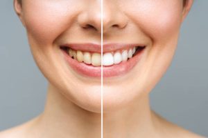 how to get yellow teeth white quickly