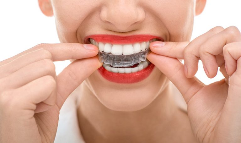 a lady is trying invisalign on her teeth