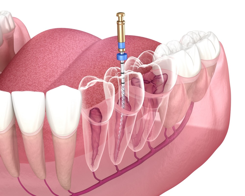 root canal therapy