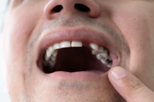 knocked-out-tooth-tips-for-saving-your-tooth-in-a-dental-emergency