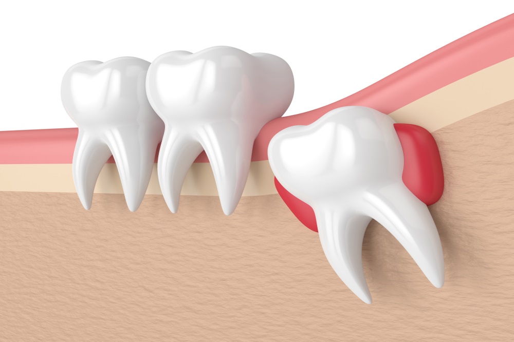 Wisdom Teeth: Signs You Should Have Them Removed